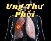 10- Bật mí bí mật: sự thật đằng sau bệnh Phế Ung | Ung thư phổi